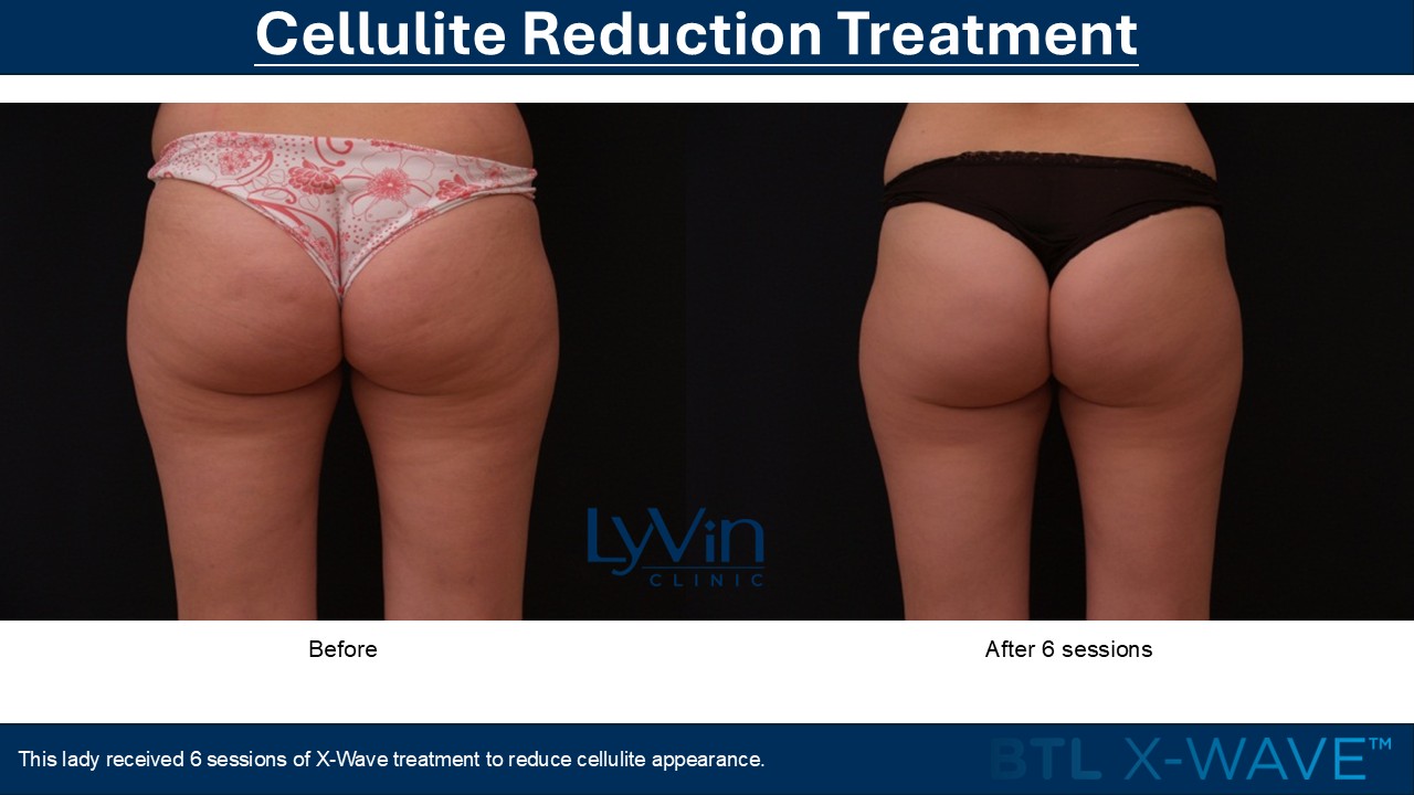 X-Wave Before and After - Second